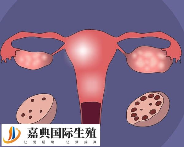 多囊卵巢的治疗方法有哪些(图1)
